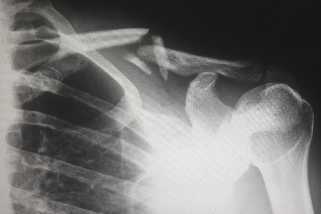 X-ray of a broken clavicle